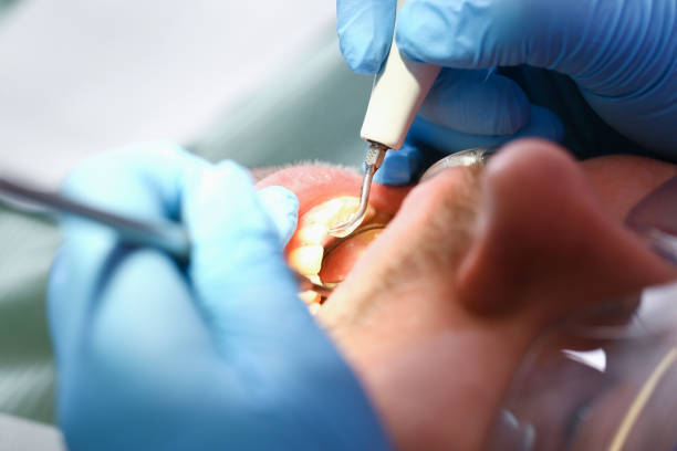 Best Emergency Treatment for Dental Infections or Abscesses in Summit, MS